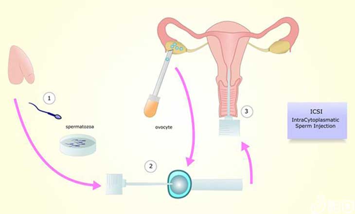 武汉单身可以做供精试管吗唇裂_胎儿唇裂的原因_胎儿唇裂怎么办